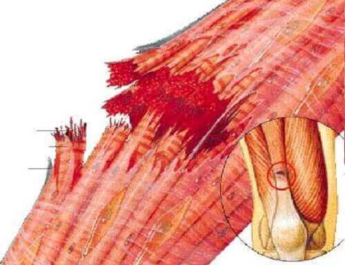 損傷の度合いによって異なる筋挫傷の症状と治療法　筋肉の図解