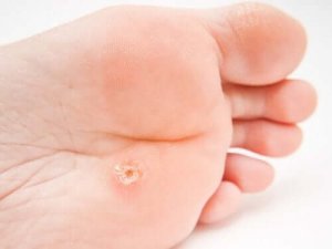 足底疣贅(足裏のイボ)の特徴と治療法