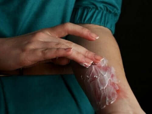 軽度の火傷:浅達性熱傷の治療方法 火傷の応急処置