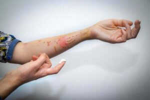 軽度の火傷:浅達性熱傷の治療方法