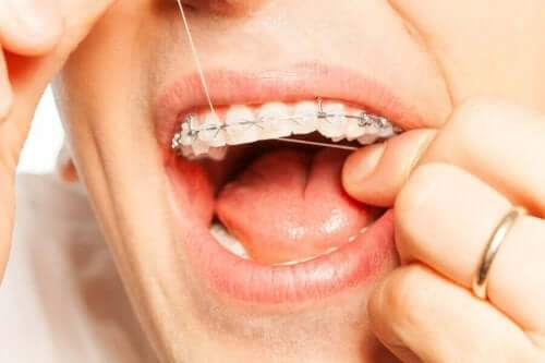 歯科矯正中に歯科衛生を良好に保つための7つの鍵　矯正中のデンタルフロス
