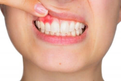 歯茎からの出血について知っておくべきすべてのこと　歯茎の腫れ