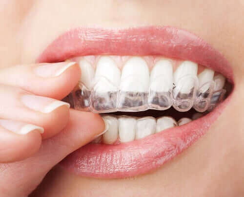 透明の歯科矯正装置：クリアアライナーについて　歯に装着する女性