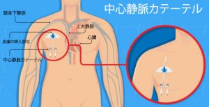 血管穿孔と中心静脈カテーテル
