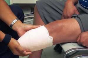 大腿切断に関して知っておくべき14のステップ