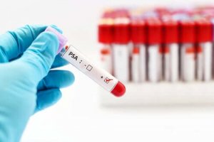 早期発見に役立てよう!前立腺がん検査の実施方法