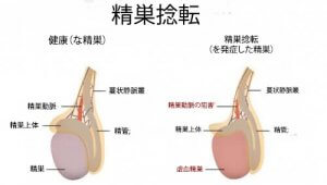 男性の病気:精巣捻転症の原因と症状
