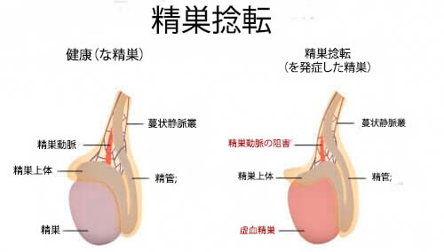 腰痛と睾丸の痛みの原因