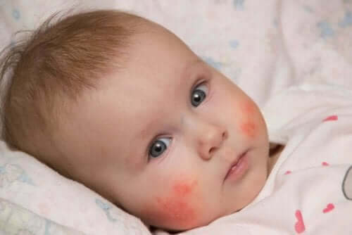 赤ちゃんのアトピー性皮膚炎の基本ケア  　頬の湿疹