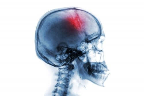 脳卒中の危険因子とその症状について　頭蓋骨