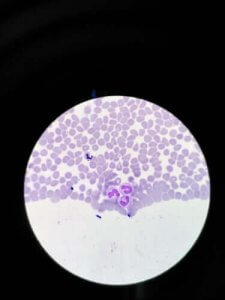 無顆粒球症:その症状と治療