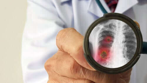 新型コロナウイルスは肺の細胞にどう感染するのか？　肺炎