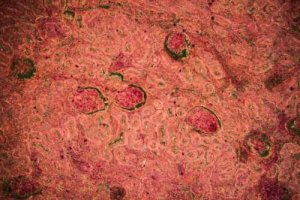 腎結核:さまざまな診断法と治療法