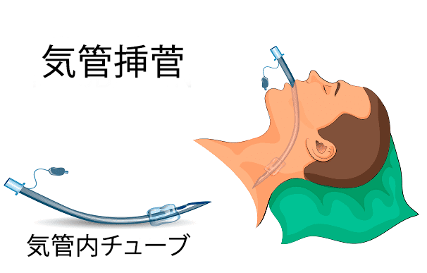 気管内チューブの種類と使い方