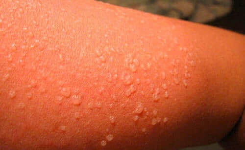 新型コロナウイルスが皮膚に与える影響について　皮膚にできた水泡
