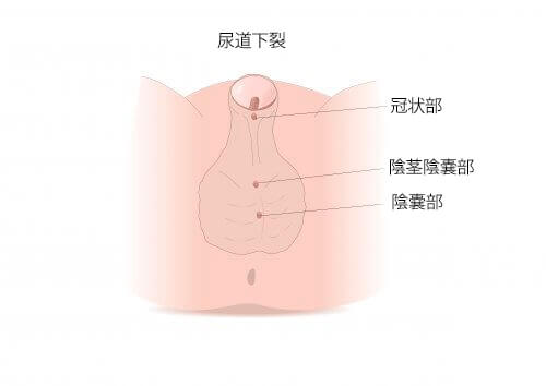 知っておきたい!尿道下裂の症状と治療について