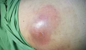 腹腔内膿瘍について知っていますか?