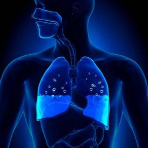 肺水腫：その原因と症状