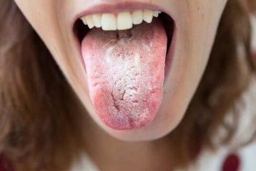 舌に黒い点