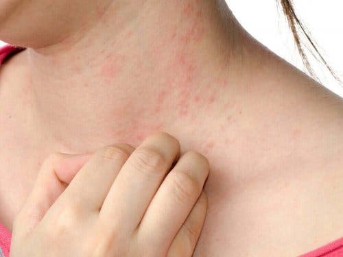 アトピー性皮膚炎について詳しく学ぼう! 診断と症状