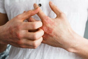 アトピー性皮膚炎について詳しく学ぼう！