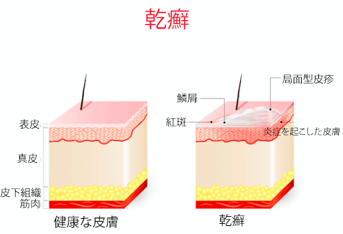 乾癬 アシトレチンの特性、適応症、用途について