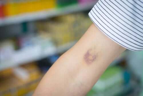 腕の青あざ
