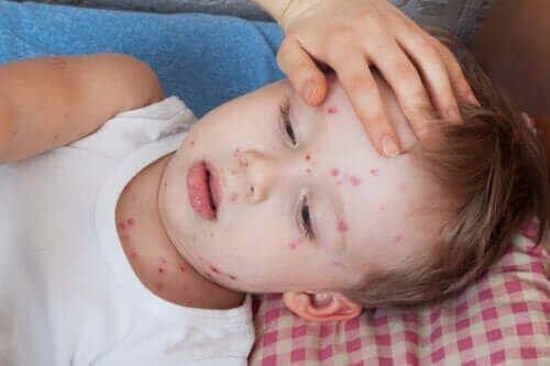 子供の蕁麻疹の治し方
