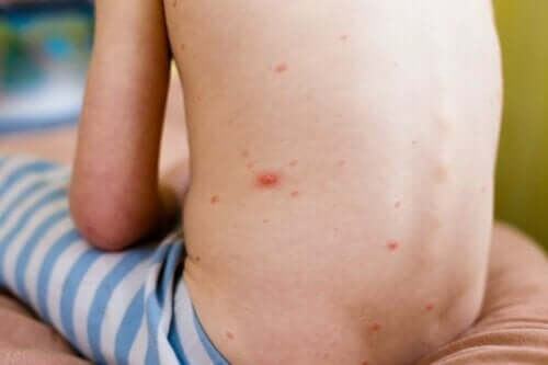 子供の蕁麻疹