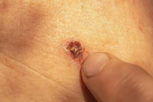 ご存じですか?イボから出血する理由 出血性イボ