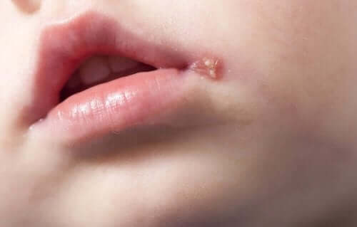 感染症　口唇ヘルペス　特徴　治療法