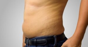 【男性のストレッチマーク】原因と自然に減らす方法