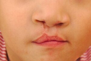 口蓋裂のある子供の歯科治療について