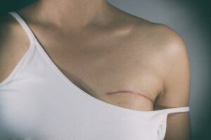 乳がん治療における手術の種類