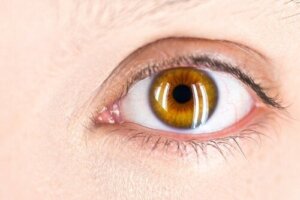 フックス角膜内皮ジストロフィーとは? 原因は?